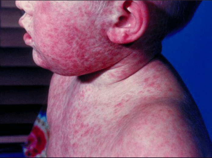 measles